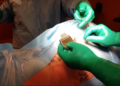 Una operació tracta el dolor neuropàtic crònic per primer cop a Andorra